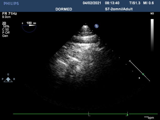 Dormed Hellas S7-2_6 TEE Cardiology