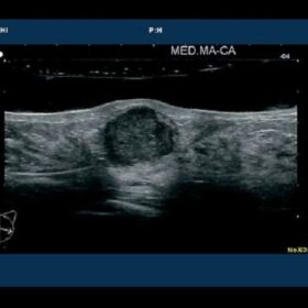 Dormed Hellas 6500HV - Breast Carcinoma