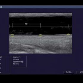 Dormed Hellas 7000HV - Vascular IMT measurement