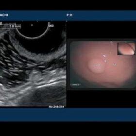 Dormed Hellas 7500HV - Endoscopic View of Cyst