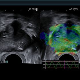 Dormed Hellas AR750 - Prostate with elastography