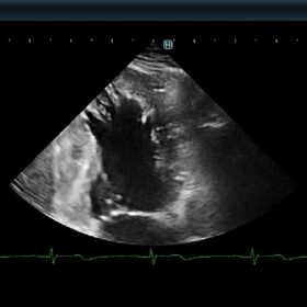 Dormed Hellas 880 Ultrasound - B Mode, Apex Details with an Hypertrophic Cardiomyopathy