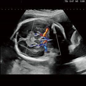 Dormed Hellas Futus - Fetal Cerebral Artery