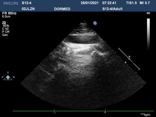 Dormed Hellas S12-4_5 Phased Array Cardiology