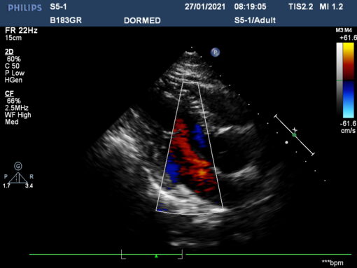 Dormed Hellas S5-1_6 Phased Array Cardiology